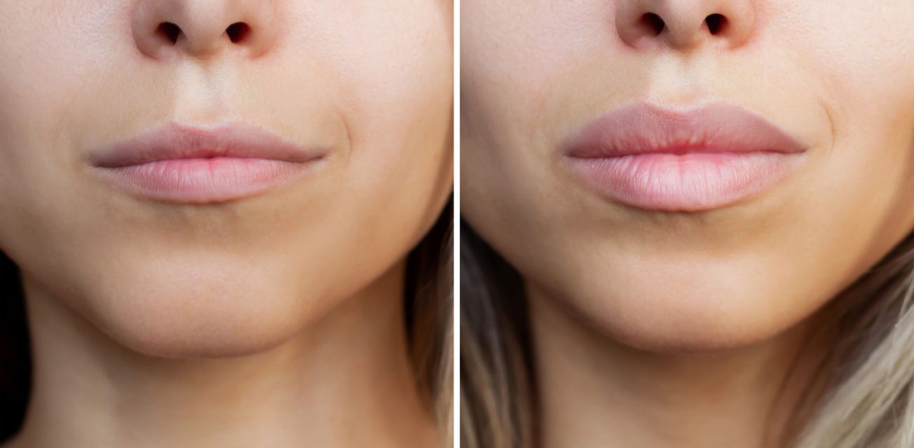 Natural Lip Filler Tampa