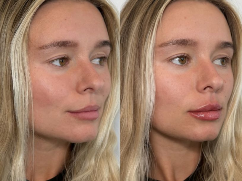 What Are Swedish Lips, and Why Are They Trending in Tampa?