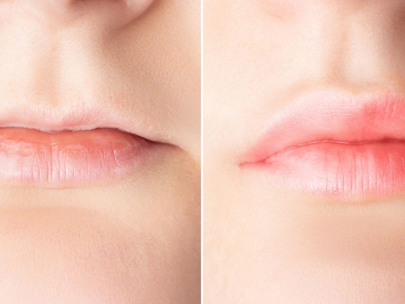 Lip Filler Migration Tampa | What Causes It?