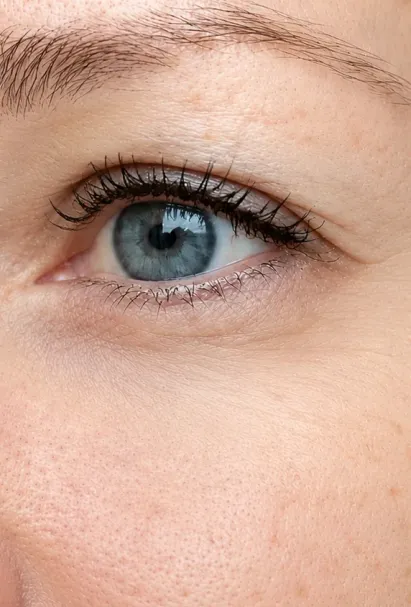 Under eye filler results