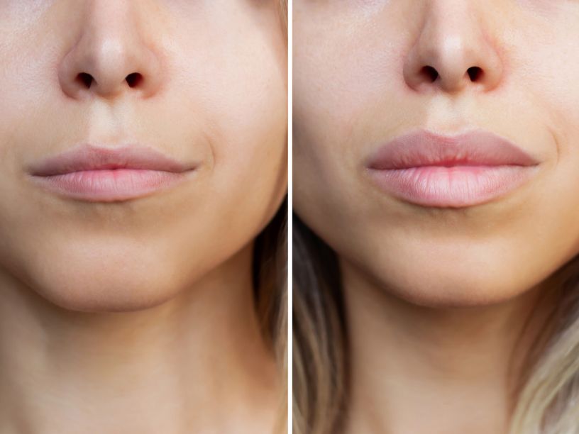 Natural Lip Filler Tampa